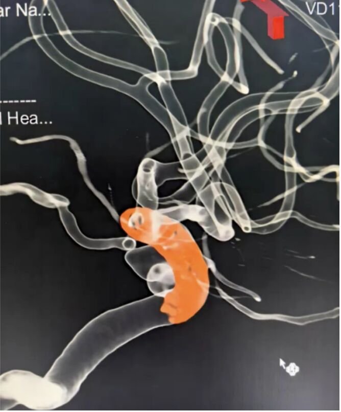 Clinical Spotlight | Simplifying the Treatment of Tandem Carotid Aneurysms with Nuva® Flow Diverter